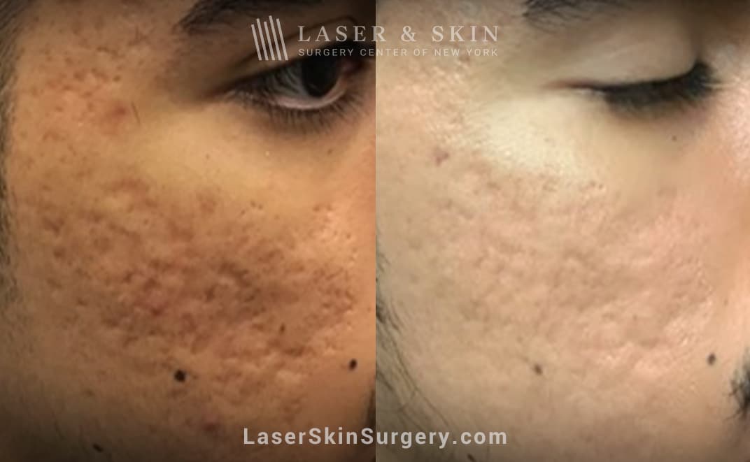 nyc laser acne treatment results