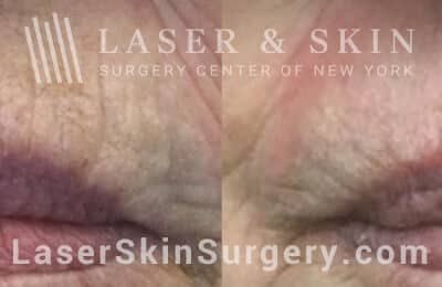 Fraxel Repair treatment for lines above the lips