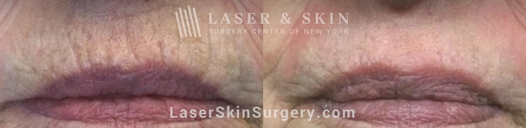 laser resurfacing for lip wrinkles