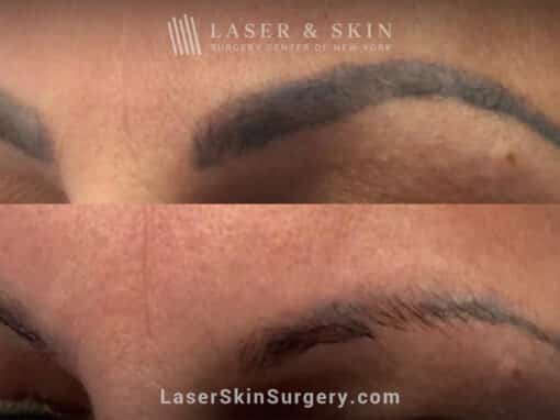 Picosure laser treatments to remove permanent makeup from eyebrows