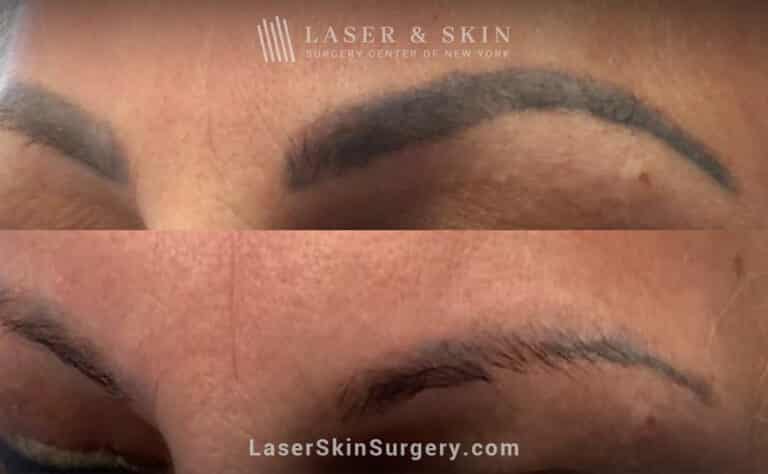 Picosure laser treatments to remove permanent makeup from eyebrows