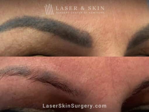 Picosure laser treatments to remove permanent makeup from eyebrows