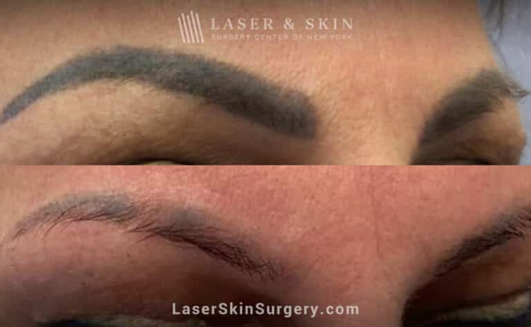 Picosure laser treatments to remove permanent makeup from eyebrows