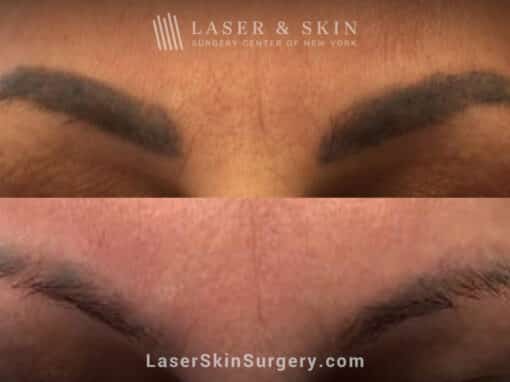 Picosure laser treatments to remove permanent makeup from eyebrows