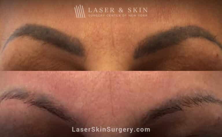 Picosure laser treatments to remove permanent makeup from eyebrows