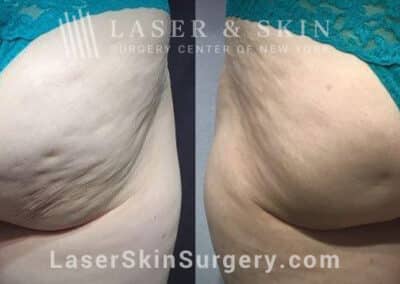 Resonic treatment for cellulite on buttocks