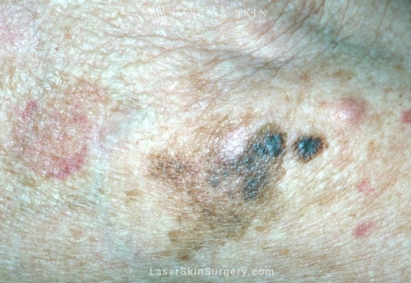 image of melanoma skin cancer