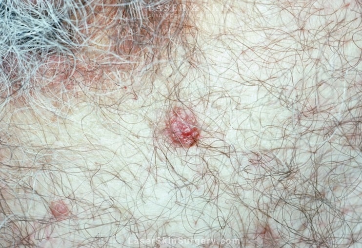 image of basal cell carcinoma