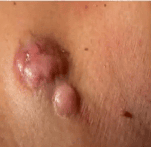 types of skin cancer-New York City image of Dermatofibrosarcoma Protuberans