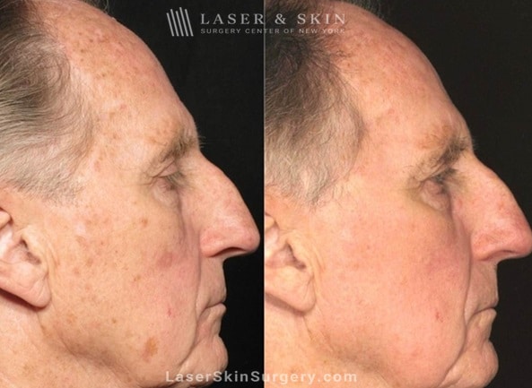 what is hyperpigmentation - NYC-NY before and after hyperpigmentation treatment results in NYC