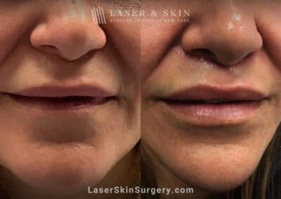 Lip Lift to improve the appearance of the lips