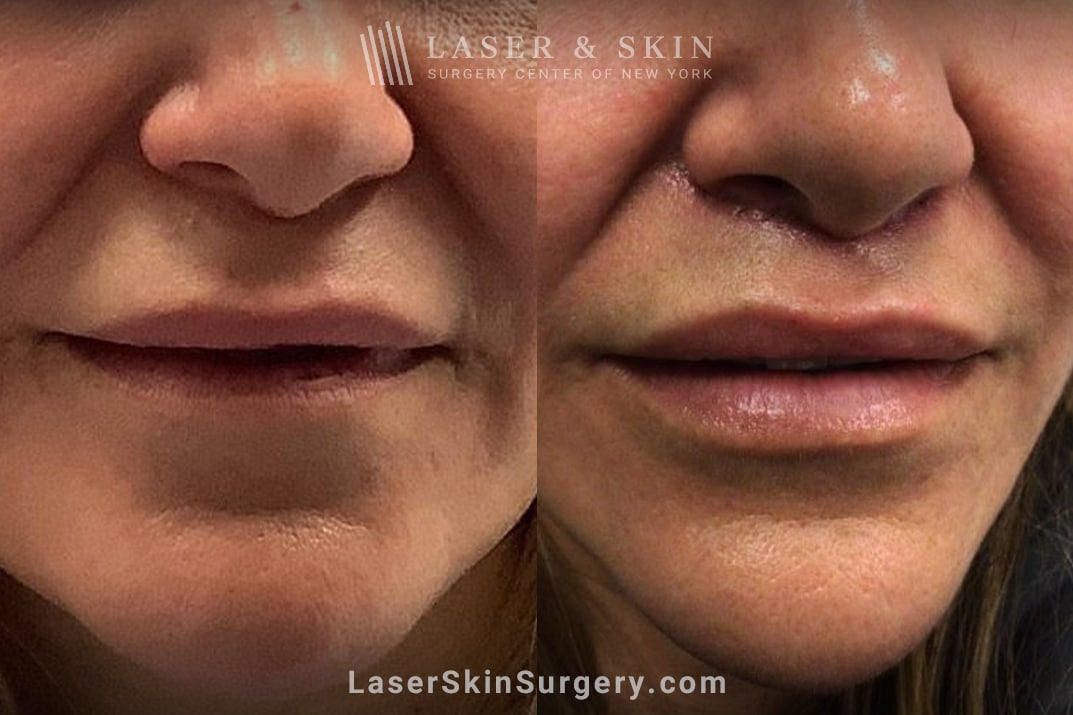 LSSC-NYC-lip-filler-before-after Laser and Skin Surgery Center of New York Image of a leg with Leg veins and after the treatment, New York, NY