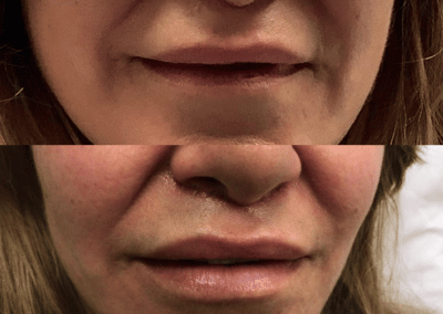 Lip lift to improve the appearance of the lips