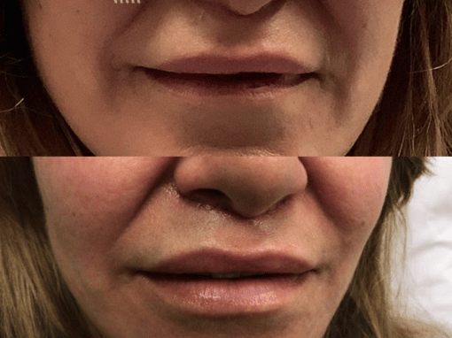 Lip lift to improve the appearance of the lips