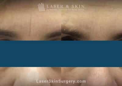 Botox and filler injections to treat permanent crease between the eyebrows