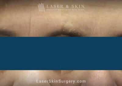 Botox and filler injections to reduce permanent crease between the eyebrows