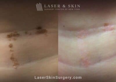 Erbium laser treatments to remove Epidermal Nevus