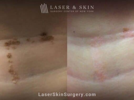 Erbium laser treatments to remove Epidermal Nevus