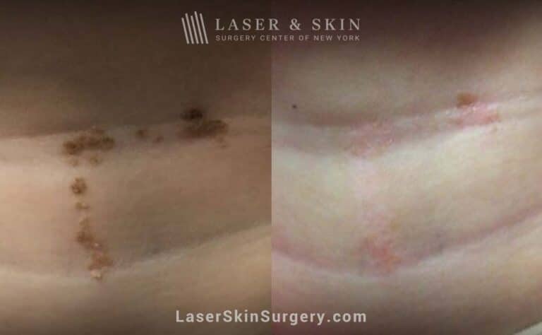 Erbium laser treatments to remove Epidermal Nevus