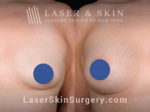 Breast augmentation to increase the size of the breasts