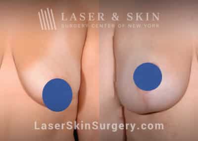 Breast augmentation to reshape and enhance the breasts