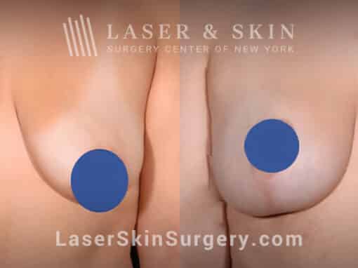 Breast augmentation to reshape and enhance the breasts