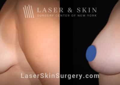 Breast augmentation to lift and increase the breast size