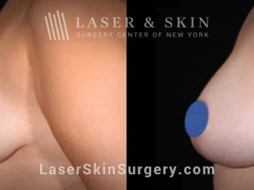 Breast augmentation to lift and increase the breast size