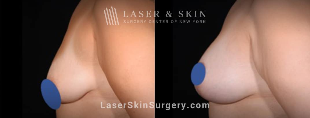 Breast augmentation to lift and increase the breast size