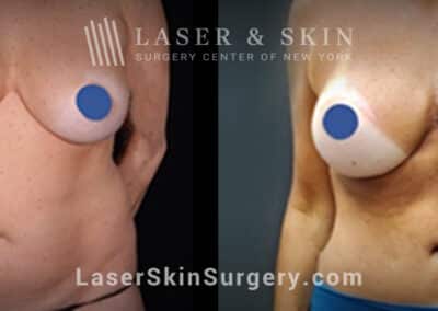 Breast augmentation to reshape and enhance the breasts