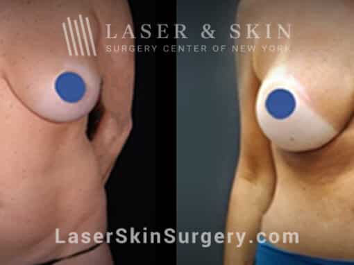 Breast augmentation to reshape and enhance the breasts