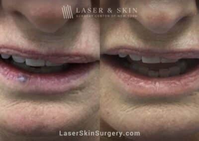 Excel V laser treatments to remove venous lake from the lower lip