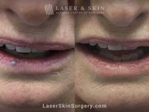 Excel V laser treatments to remove venous lake from the lower lip