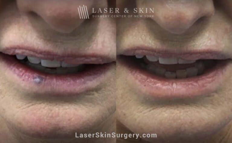 Excel V laser treatments to remove venous lake from the lower lip