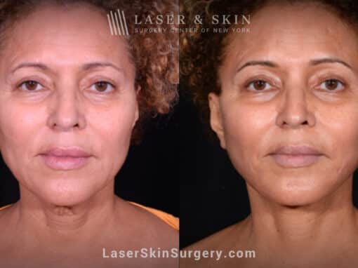 Facelift to rejuvenate the face and neck