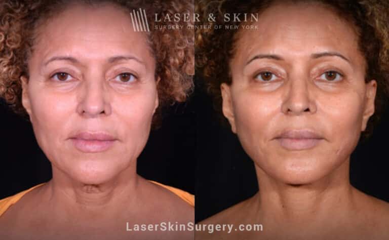 Facelift to rejuvenate the face and neck