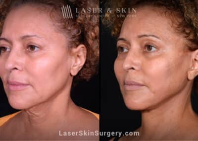 Facelift to rejuvenate the face and neck