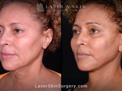 Facelift to rejuvenate the face and neck