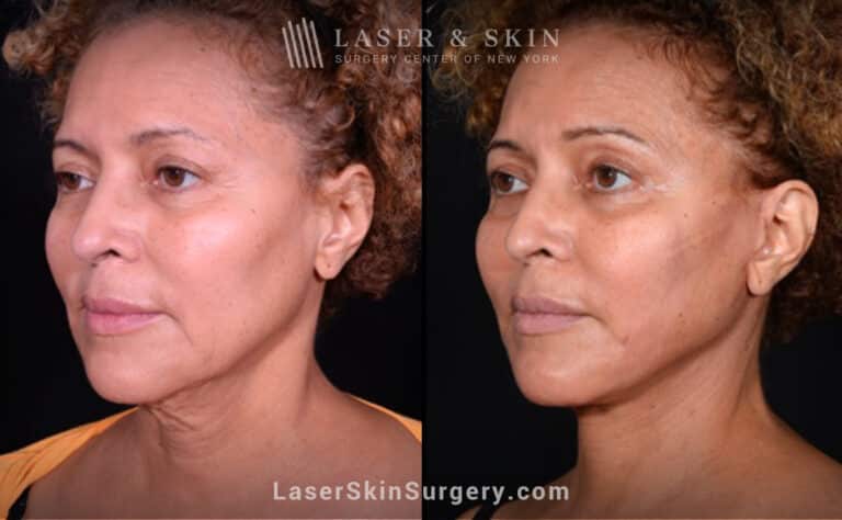 Facelift to rejuvenate the face and neck