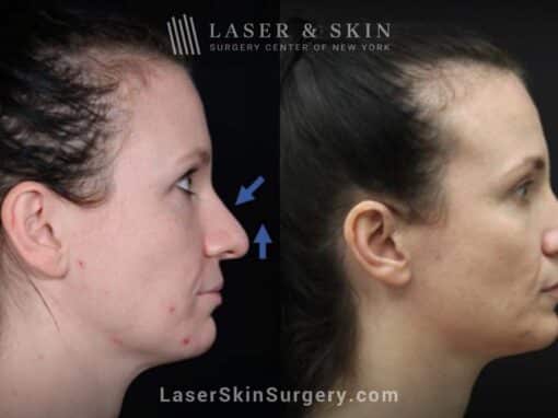 Rhinoplasty to reshape the nose