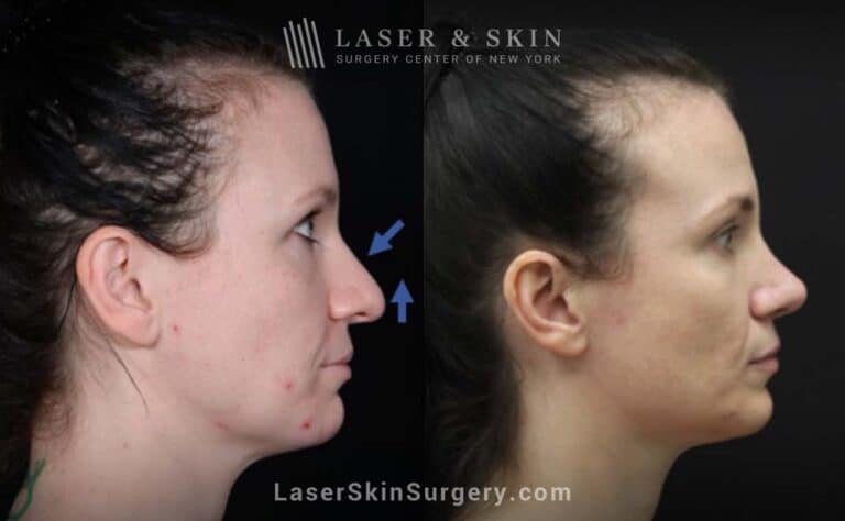 Rhinoplasty to reshape the nose