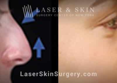 Rhinoplasty to lift the nasal tip and remove the dorsal hump