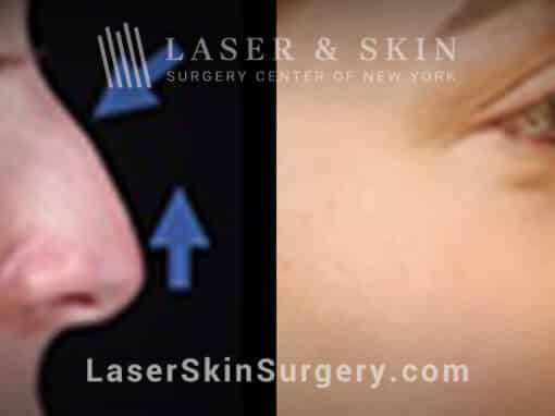 Rhinoplasty to lift the nasal tip and remove the dorsal hump