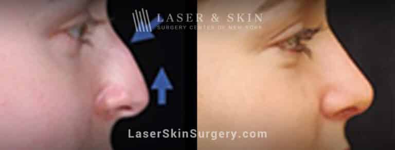 Rhinoplasty to lift the nasal tip and remove the dorsal hump