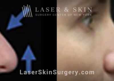 Rhinoplasty to reduce the dorsal hump and lift the nasal tip