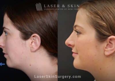 Rhinoplasty to improve the appearance of the nose