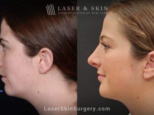 Rhinoplasty to improve the appearance of the nose