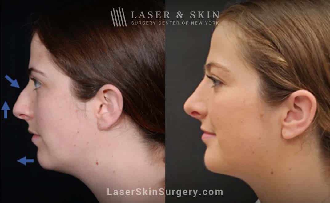 rhinoplasty before and after