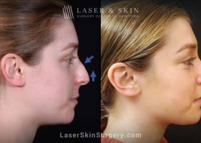 Rhinoplasty to reduce the dorsal hump