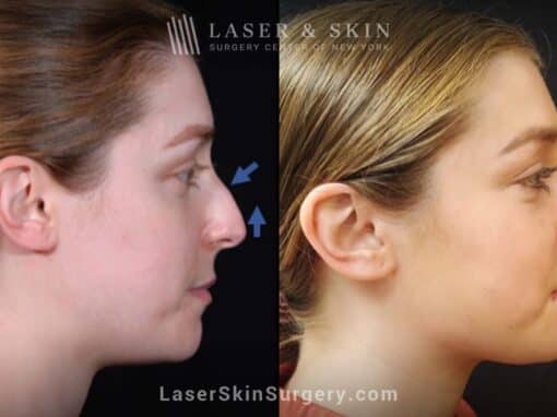 Rhinoplasty to improve the appearance of the nose